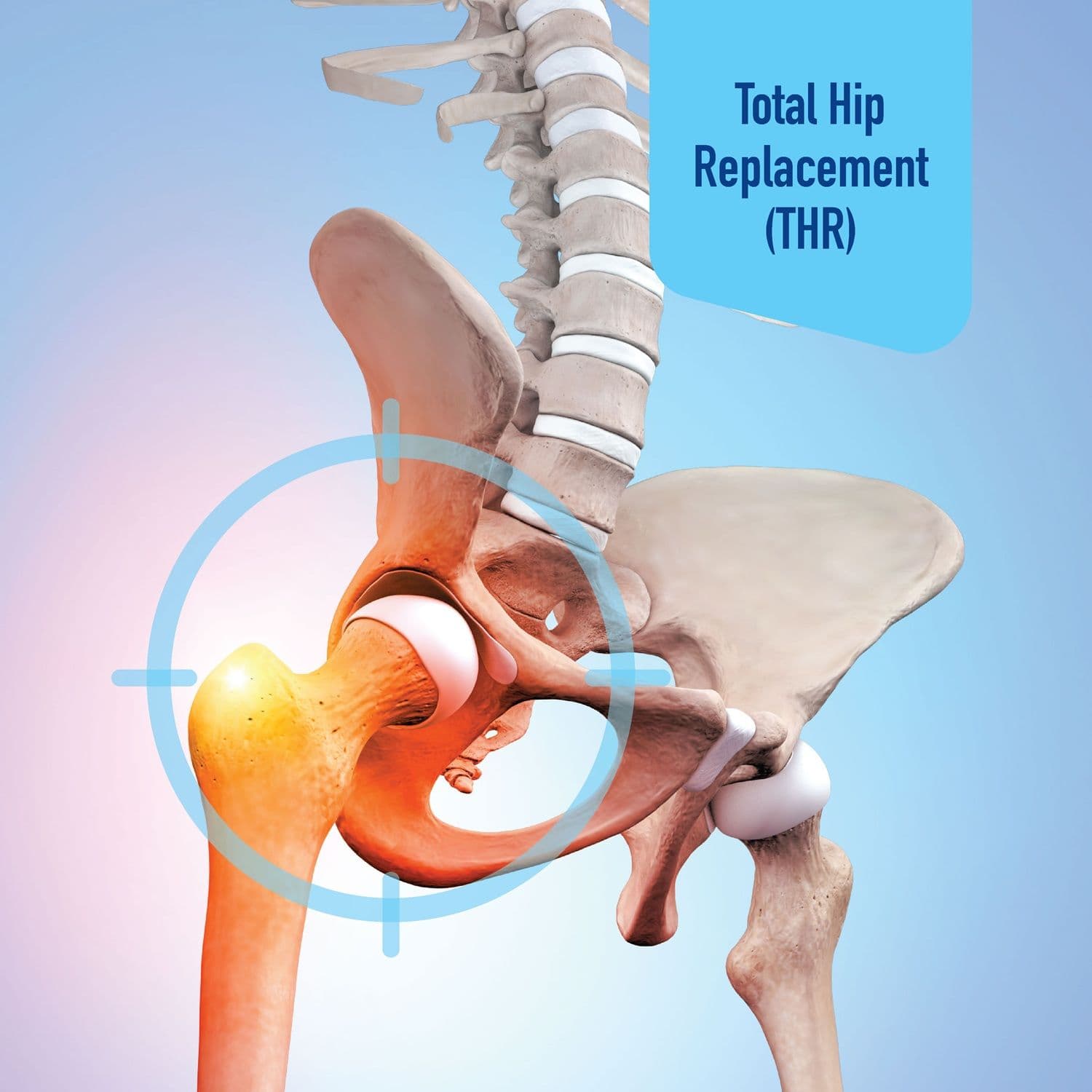 Total Hip Replacement